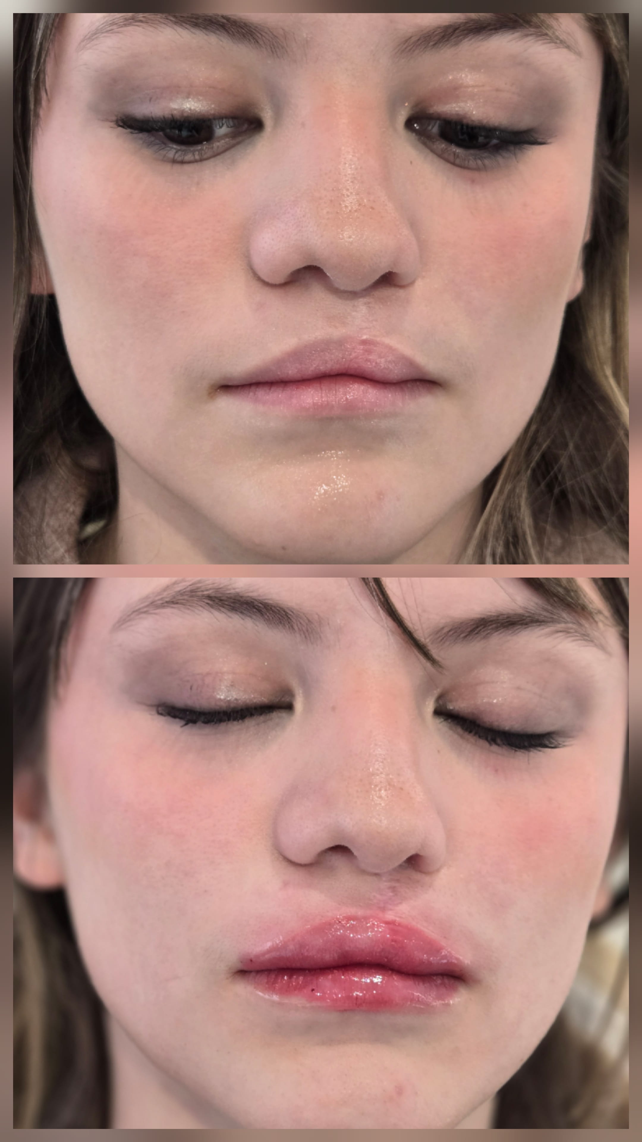 Cleft Lip Mariya Aesthetics Nottingham