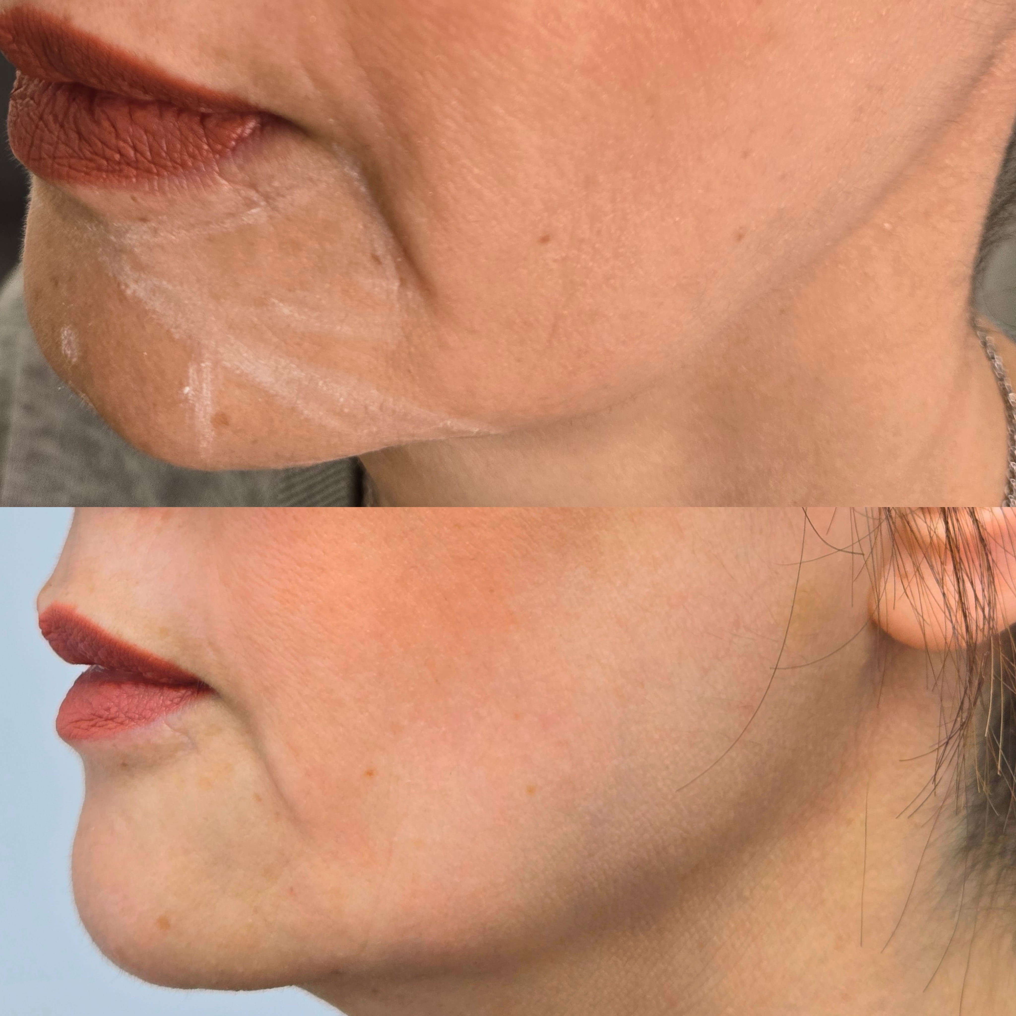 Lower Face Mariya Aesthetics Nottingham