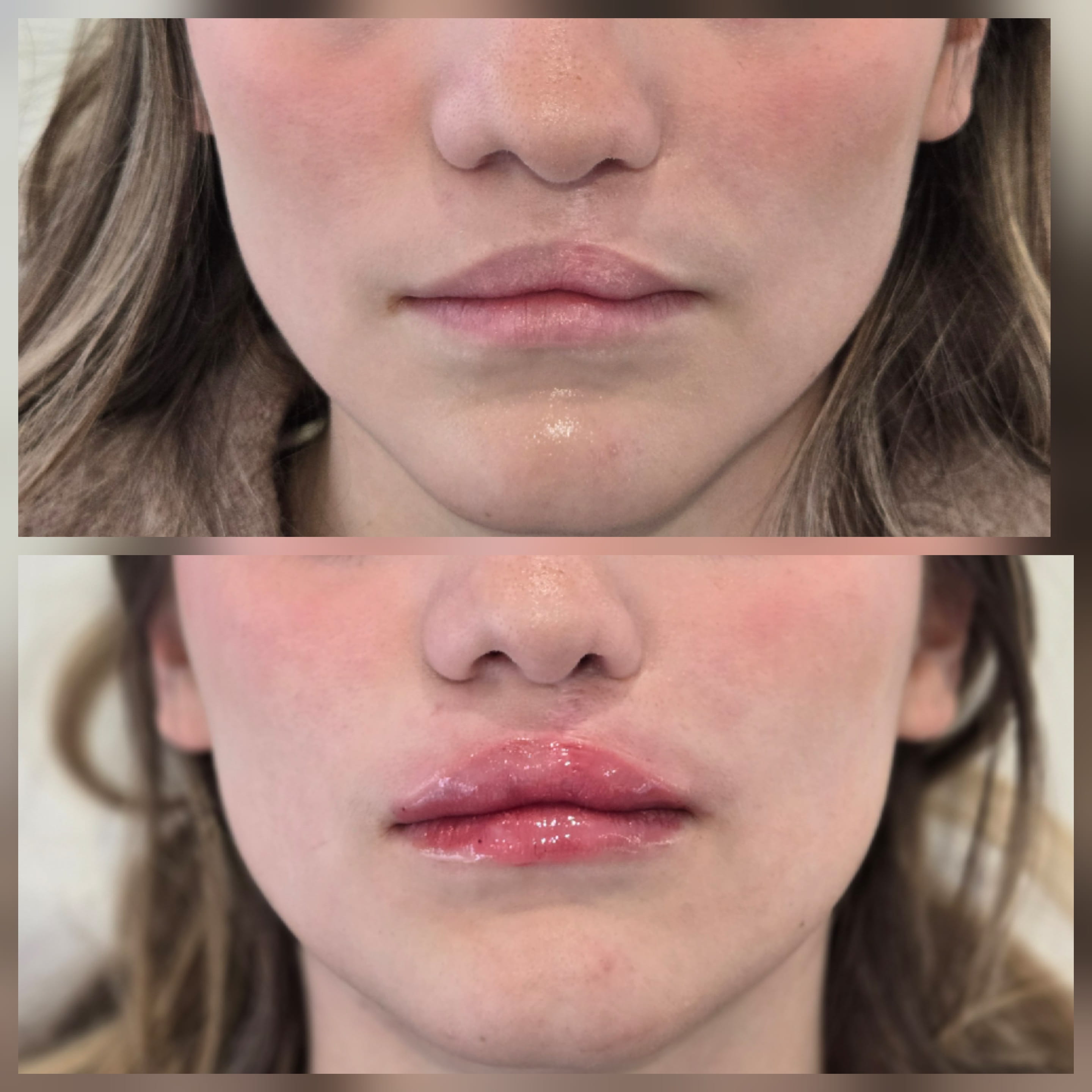 Cleft Lip Mariya Aesthetics Nottingham
