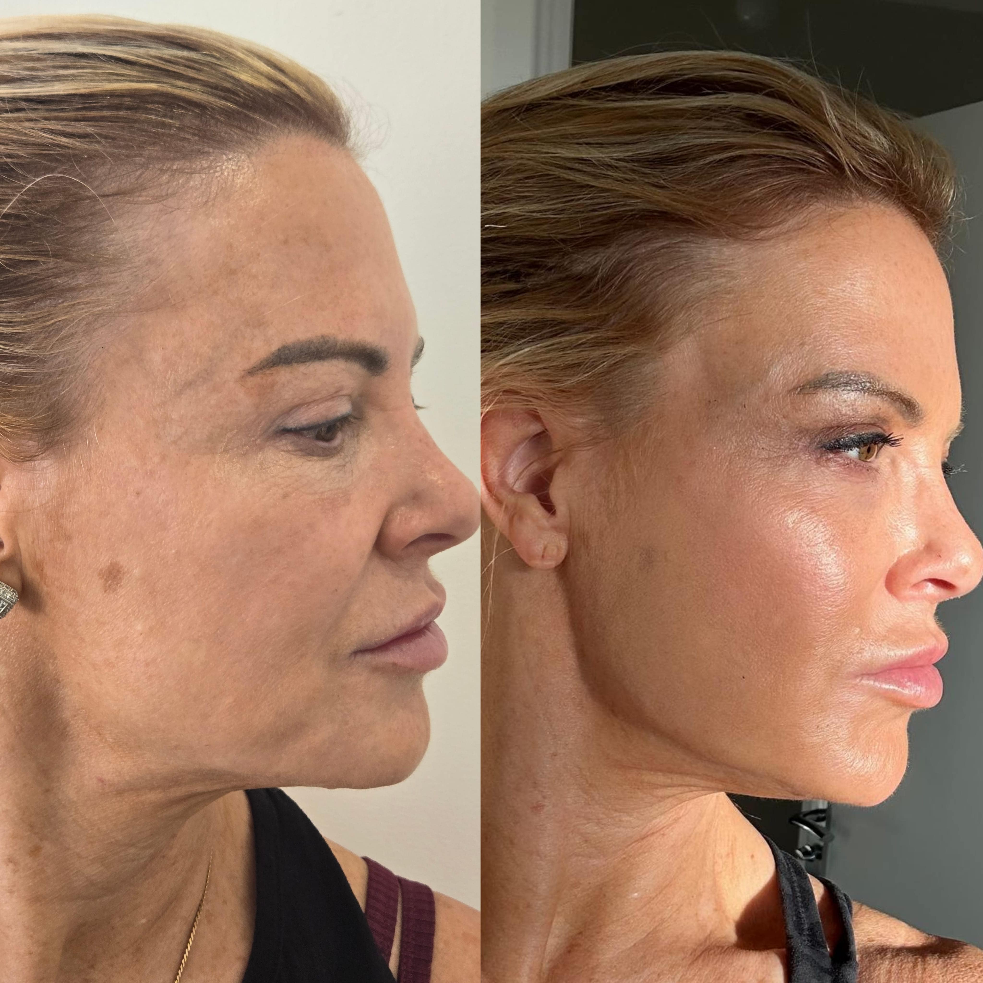 Lower Face Mariya Aesthetics Nottingham