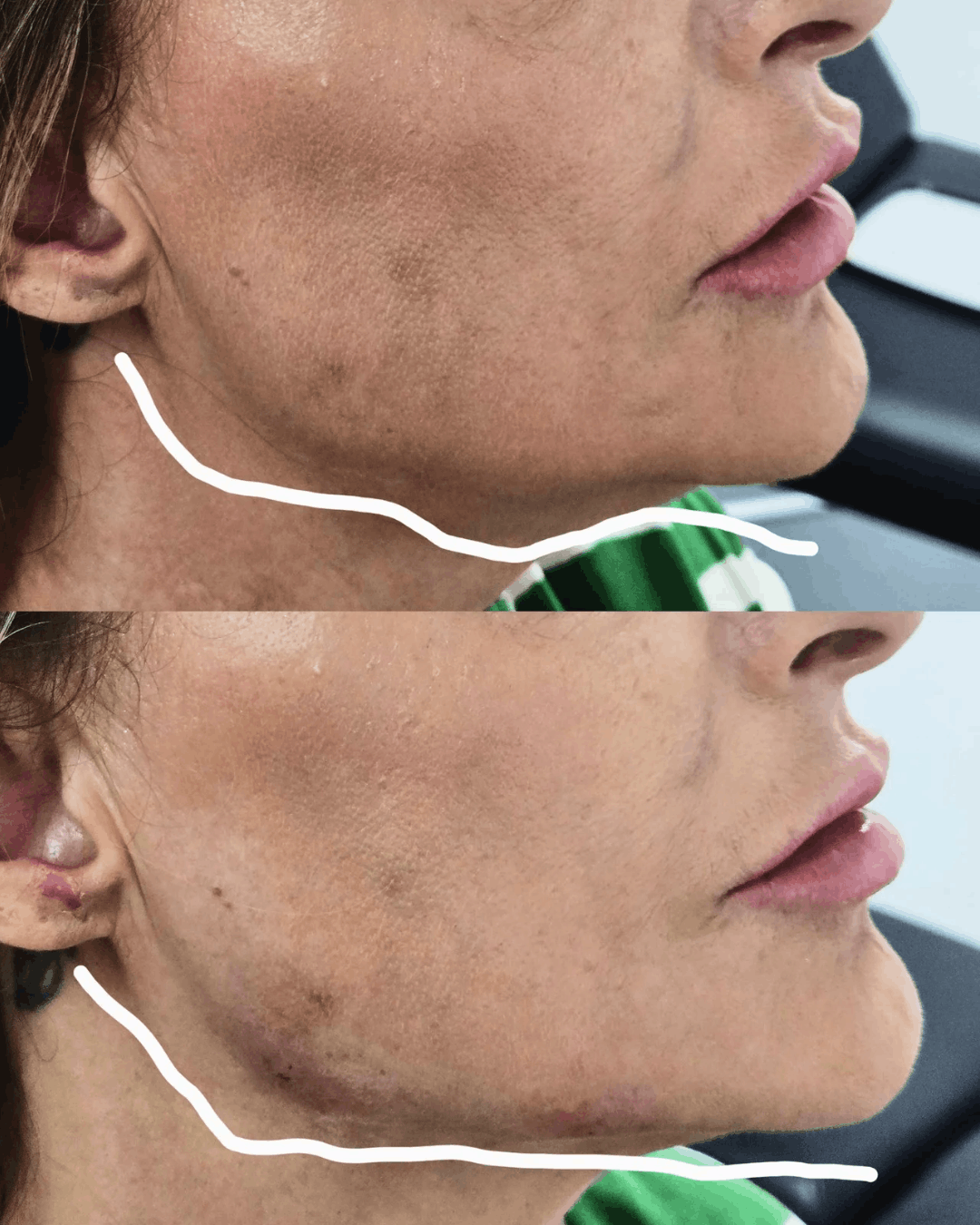 Lower Face Mariya Aesthetics Nottingham