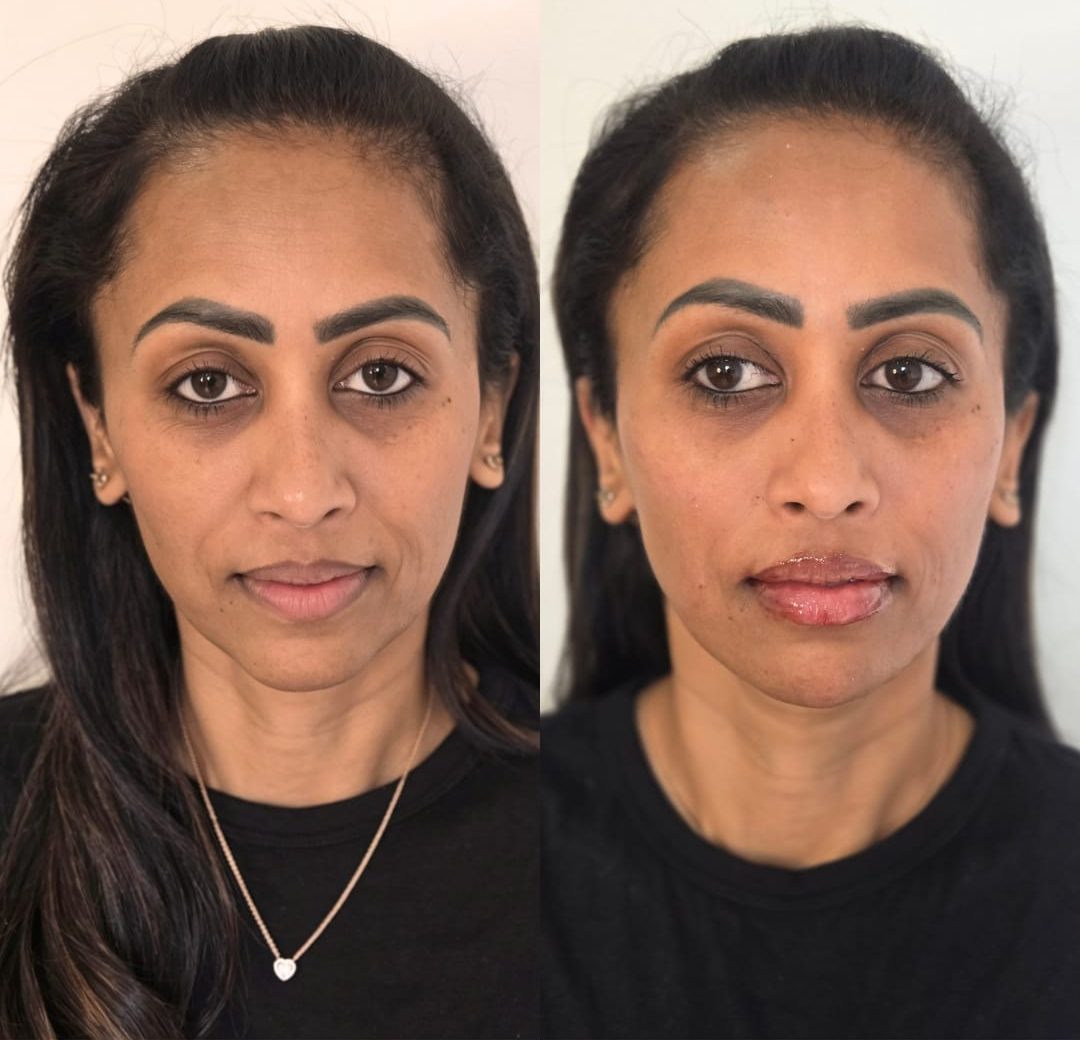 Facial Harmonisation