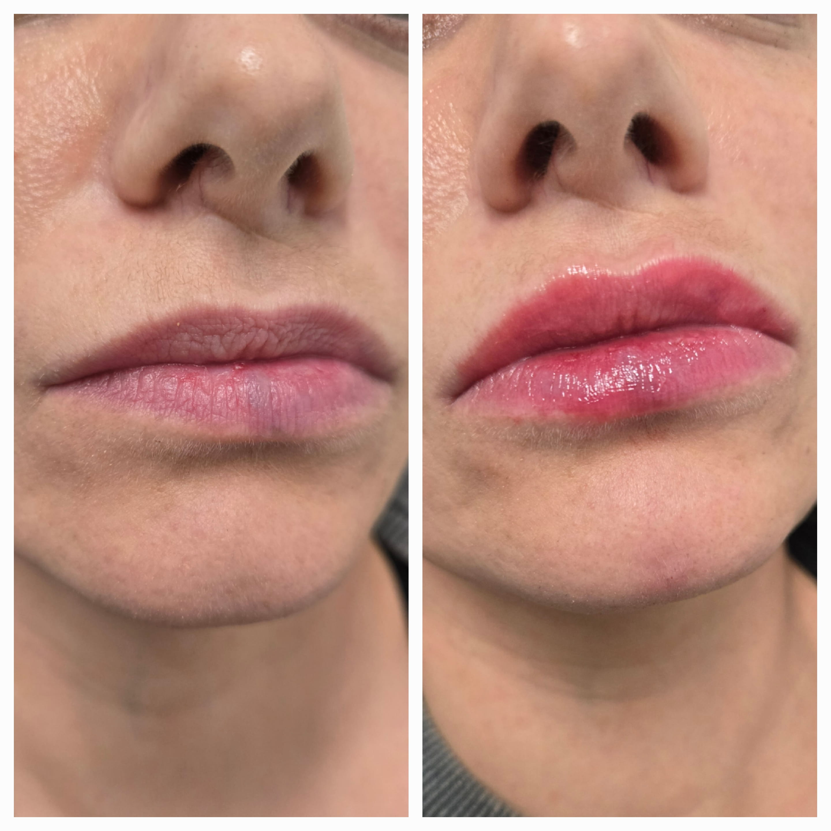 Lip Mariya Aesthetics Nottingham