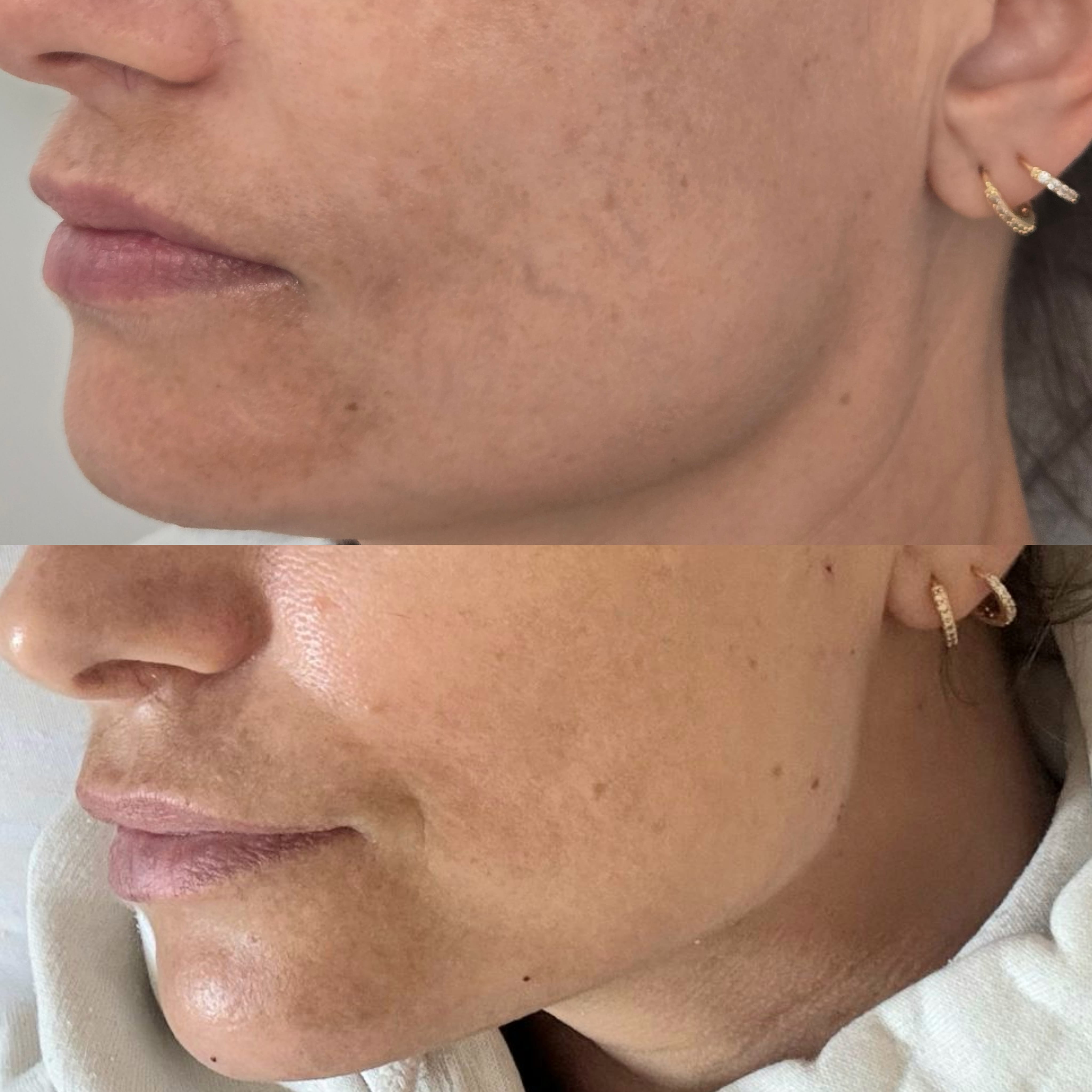Lower Face Mariya Aesthetics Nottingham