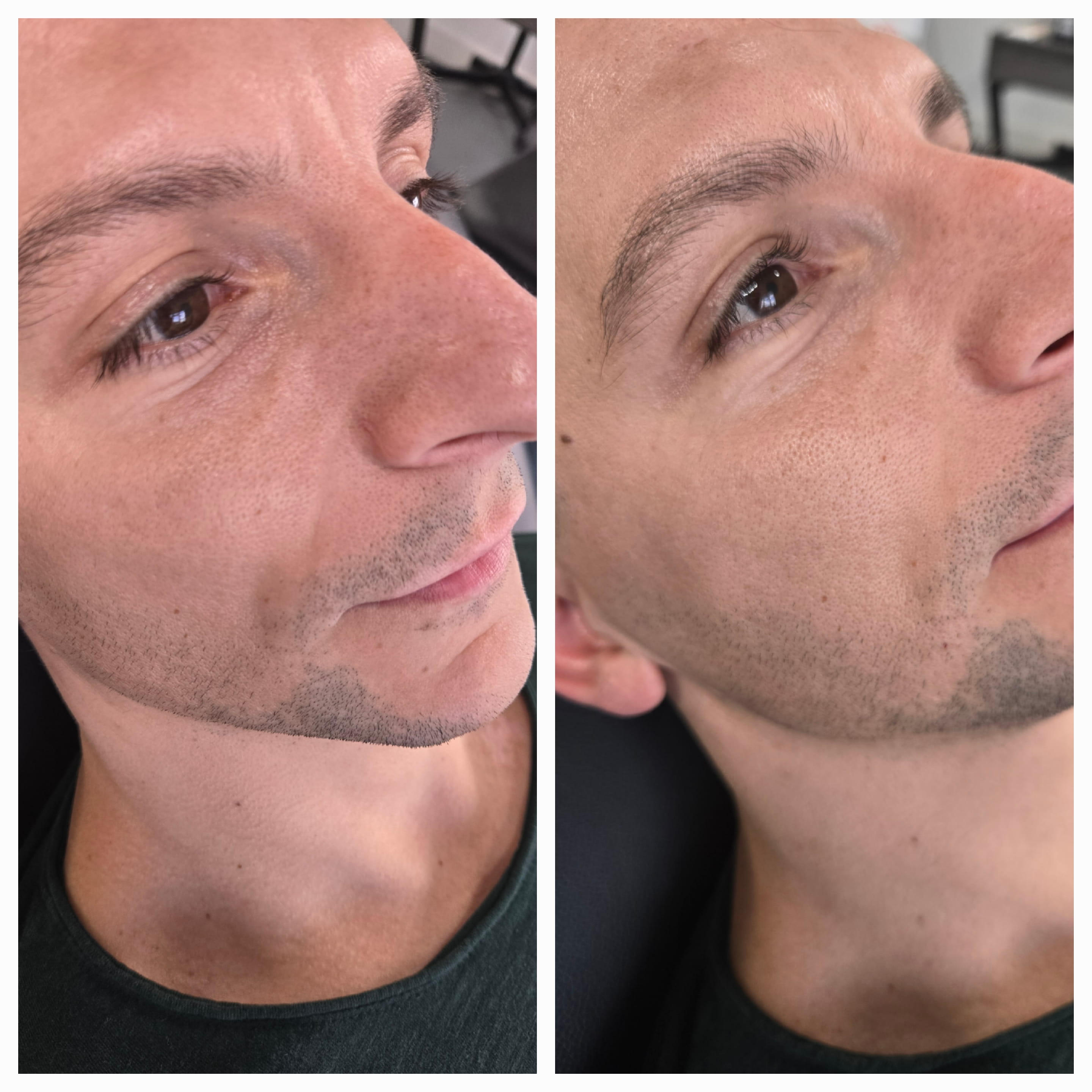 Lower Face Mariya Aesthetics Nottingham