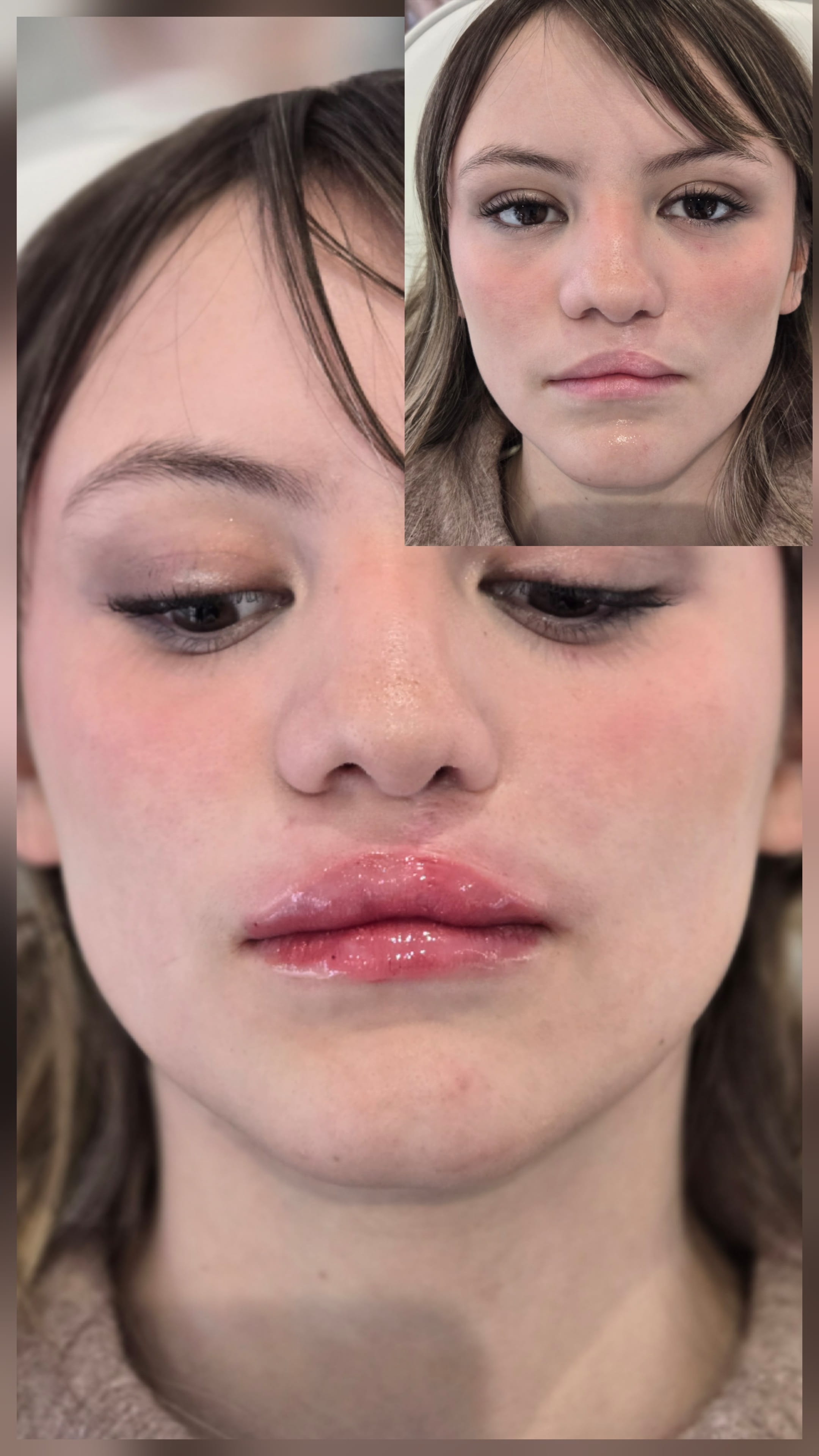 Cleft Lip Mariya Aesthetics Nottingham