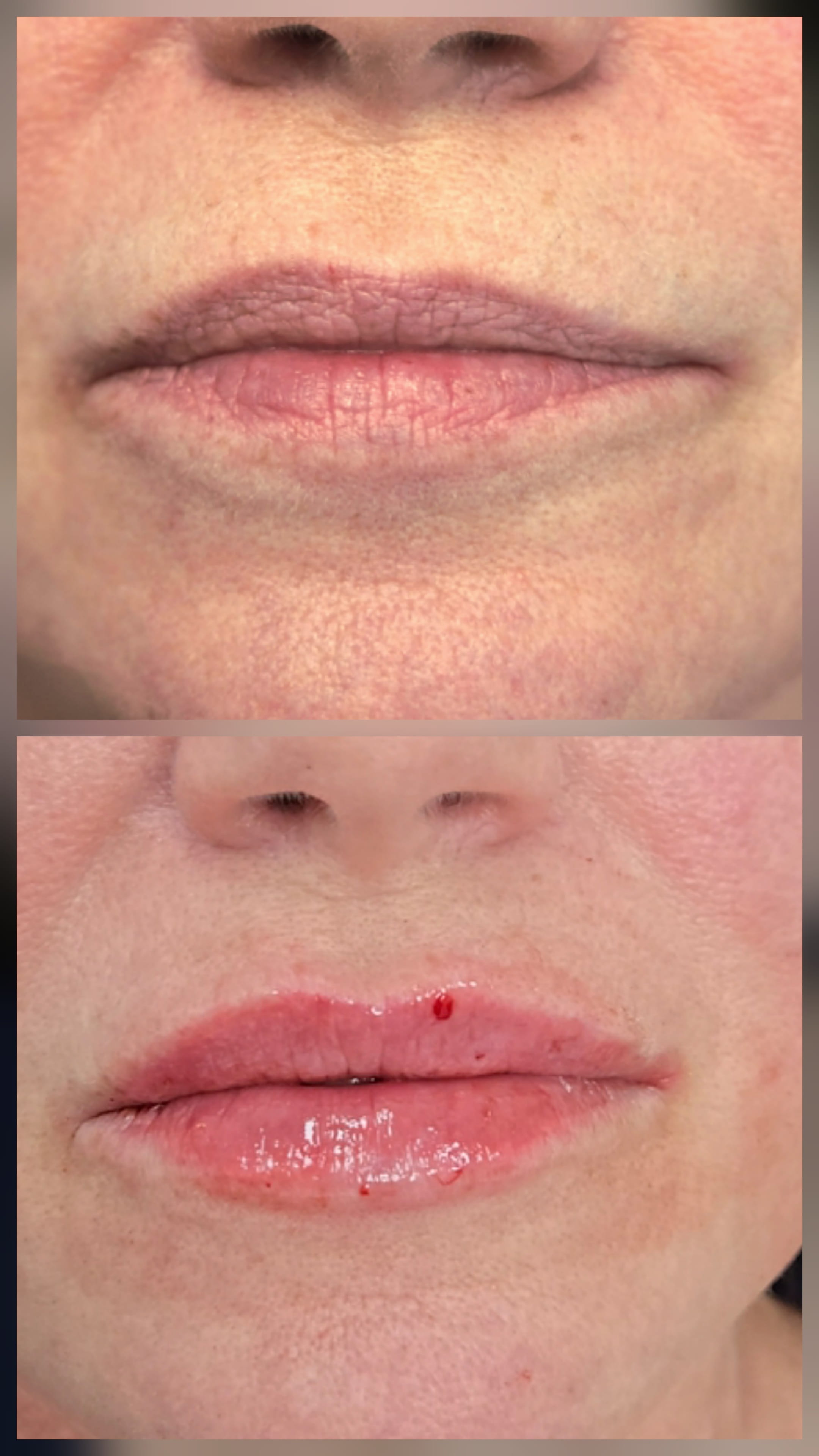 Lip Mariya Aesthetics Nottingham