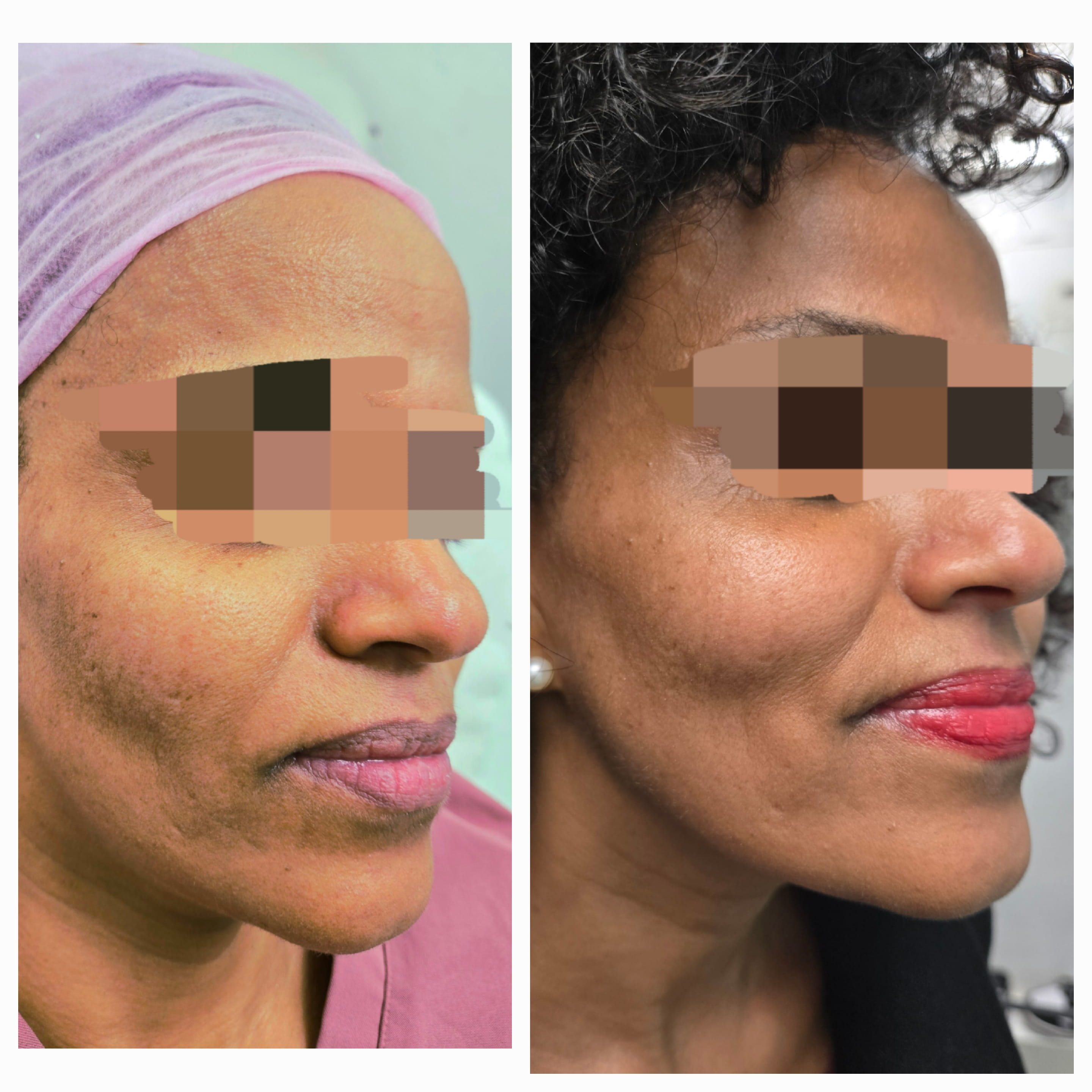 Lower Face Mariya Aesthetics Nottingham