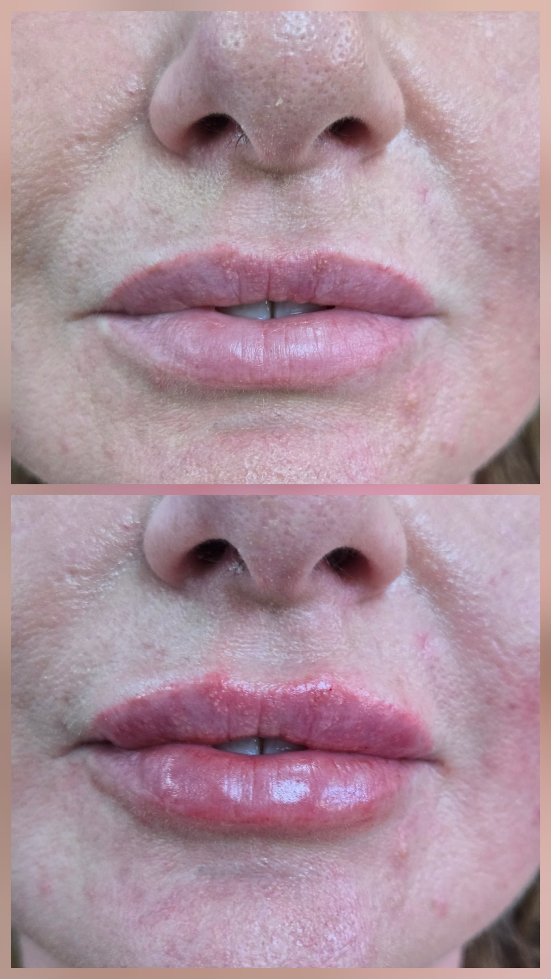 Lip Mariya Aesthetics Nottingham
